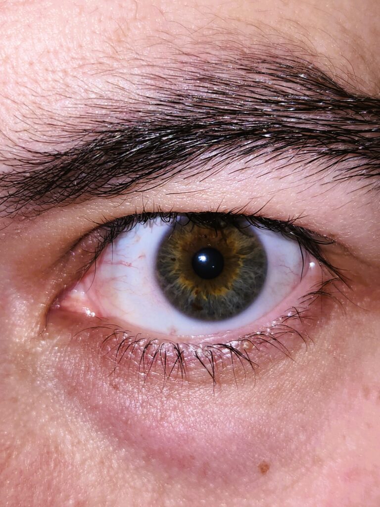 Image of an eye with a potential eye injury